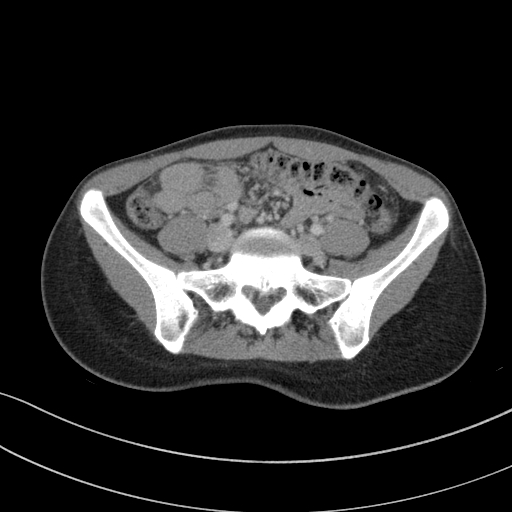 Acute appendicitis (Radiopaedia 62608-70901 Axial C+ portal venous phase 9).jpg
