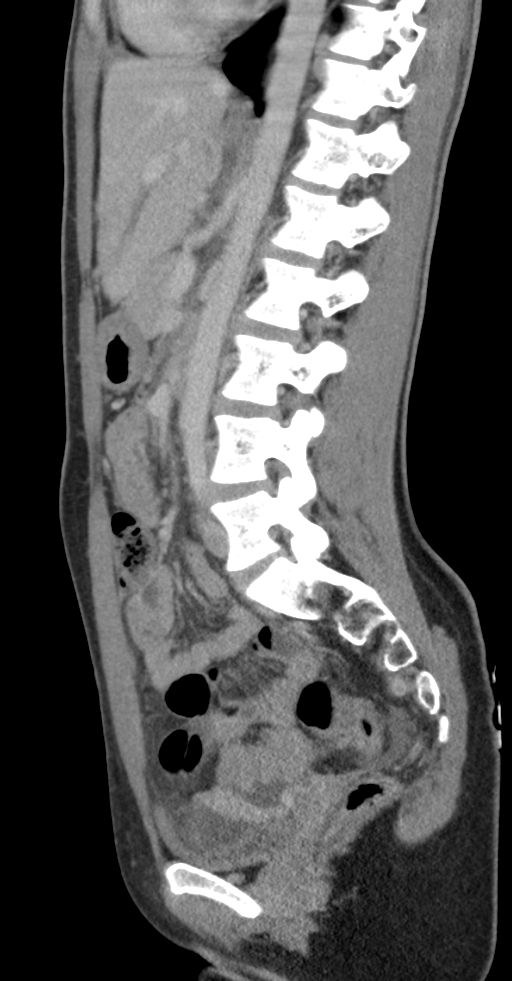 Acute appendicitis (Radiopaedia 62608-70901 Sagittal C+ portal venous phase 13).jpg