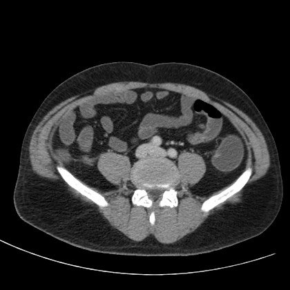 Acute appendicitis (Radiopaedia 66513-75790 Axial C+ portal venous phase 55).jpg