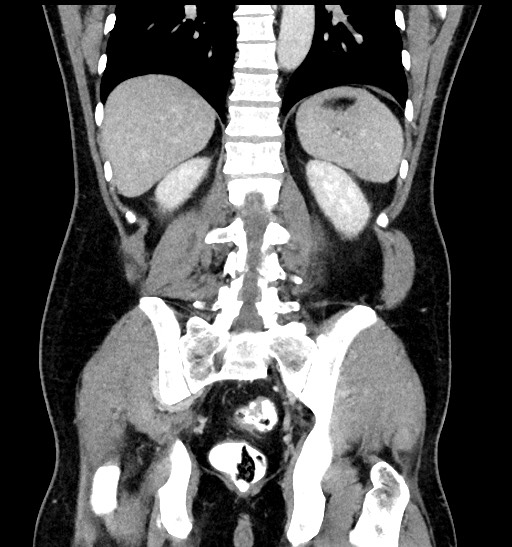 Acute appendicitis (Radiopaedia 77016-88960 Coronal C+ portal venous phase 71).jpg