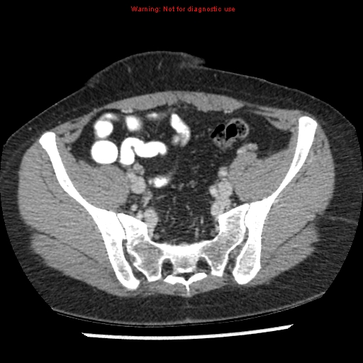 Acute appendicitis (Radiopaedia 7966-8812 C+ portal venous phase 41).jpg