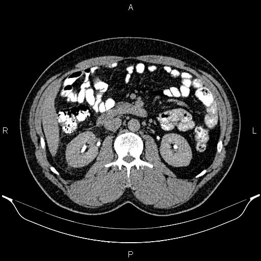 File:Acute appendicitis (Radiopaedia 84780-100240 Axial C+ delayed 45).jpg
