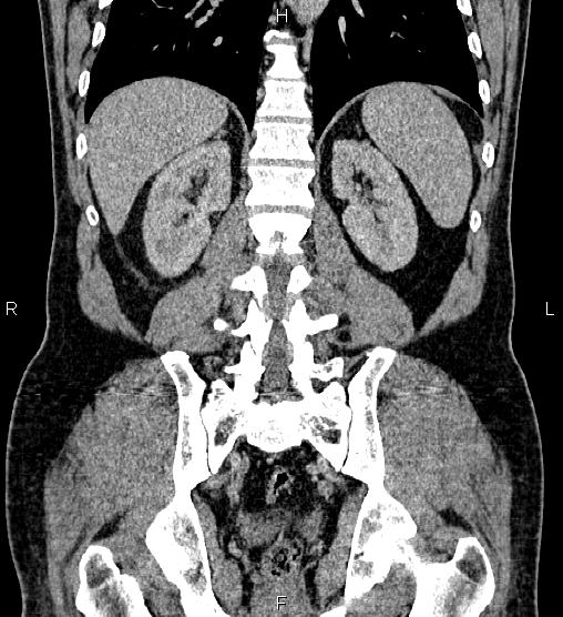 Acute appendicitis (Radiopaedia 84780-100240 Coronal C+ portal venous phase 59).jpg