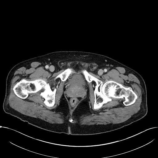 File:Acute appendicitis - large appendicoliths (Radiopaedia 61805-69820 Axial 102).jpg