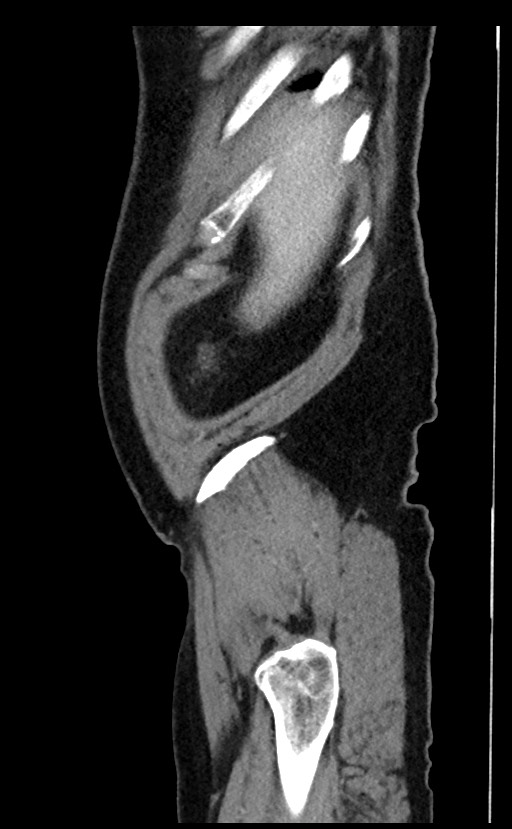 Acute appendicitis - large appendicoliths (Radiopaedia 61805-69820 Sagittal C+ portal venous phase 105).jpg