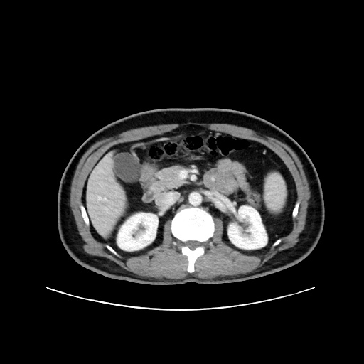 Acute appendicitis and COVID 19 pneumonia (Radiopaedia 76604-88380 Axial C+ portal venous phase 30).jpg