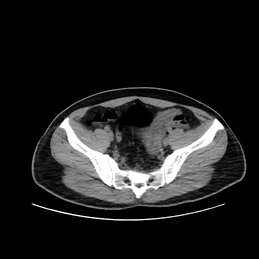 Acute appendicitis and COVID 19 pneumonia (Radiopaedia 76604-88380 Axial non-contrast 104).jpg