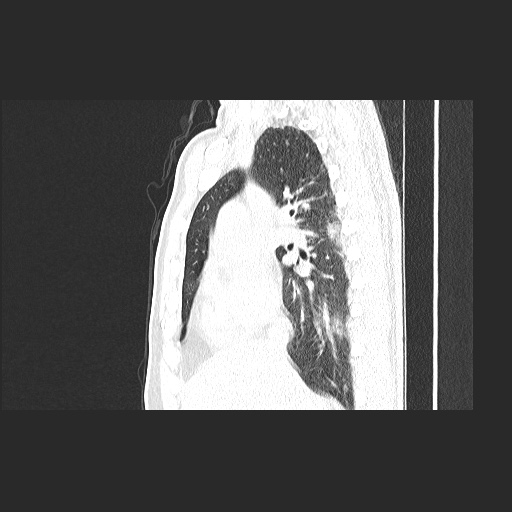 Acute appendicitis and COVID 19 pneumonia (Radiopaedia 76604-88380 Sagittal lung window 38).jpg