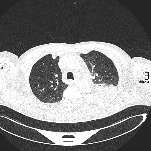 Acute aspiration pneumonitis (Radiopaedia 55642-62166 Axial lung window 56).jpg