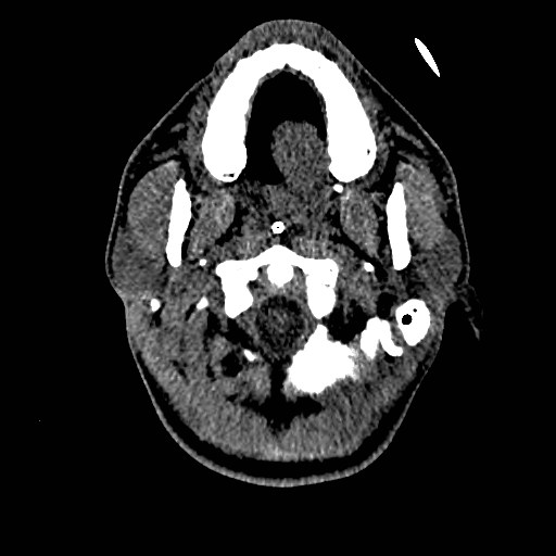 Acute basilar artery occlusion (Radiopaedia 43582-46985 Axial non-contrast 21).jpg