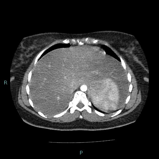 Acute bilateral pyelonephritis (Radiopaedia 37146-38881 Axial C+ arterial phase 19).jpg