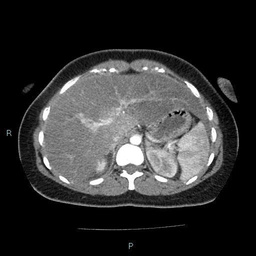 Acute bilateral pyelonephritis (Radiopaedia 37146-38881 Axial C+ arterial phase 41).jpg