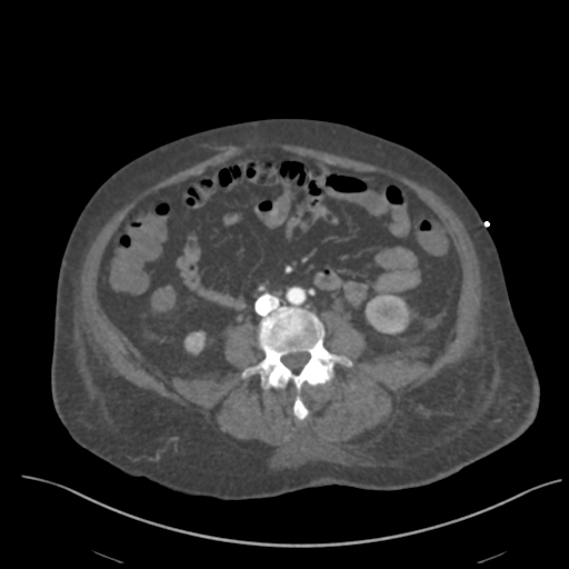 File:Acute bleed from gastric fundus biopsy site (Radiopaedia 35201-36737 Coronal C+ arterial phase 1).png