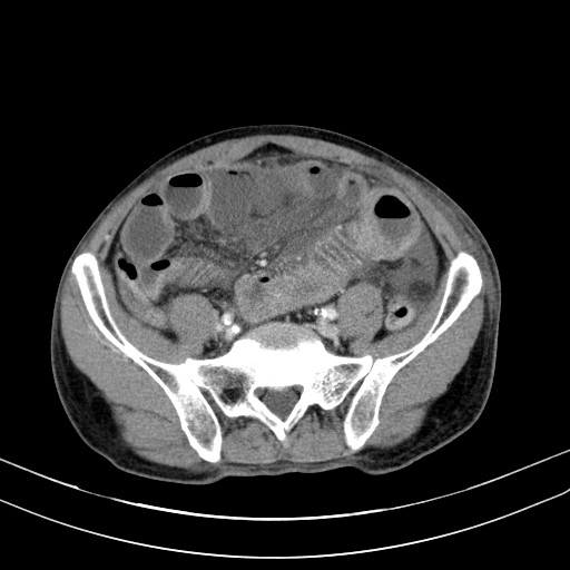 Acute bowel ischemia (Radiopaedia 87695-104114 Axial C+ portal venous phase 62).jpg