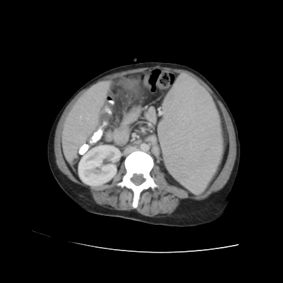 Acute calculous cholecystitis in patient with osteopetrosis (Radiopaedia 77871-90159 Axial C+ portal venous phase 46).jpg