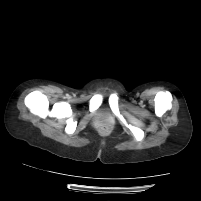 Acute calculous cholecystitis in patient with osteopetrosis (Radiopaedia 77871-90159 Axial C+ portal venous phase 81).jpg