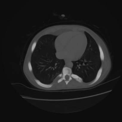 File:Acute calculous cholecystitis in patient with osteopetrosis (Radiopaedia 77871-90159 Axial bone window 1).jpg