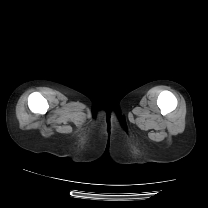 File:Acute calculous cholecystitis in patient with osteopetrosis (Radiopaedia 77871-90159 Axial non-contrast 89).jpg