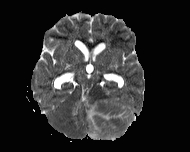 File:Acute cerebellar ataxia (Radiopaedia 61487-69446 Axial ADC 8).jpg