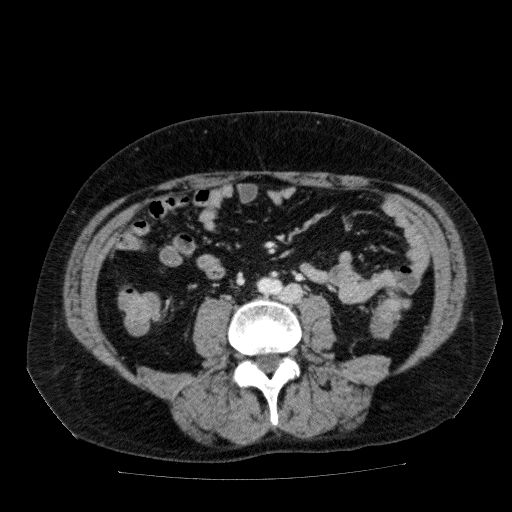 Acute cholecystitis and incidental left sided IVC (Radiopaedia 49352-54459 Axial C+ portal venous phase 90).jpg