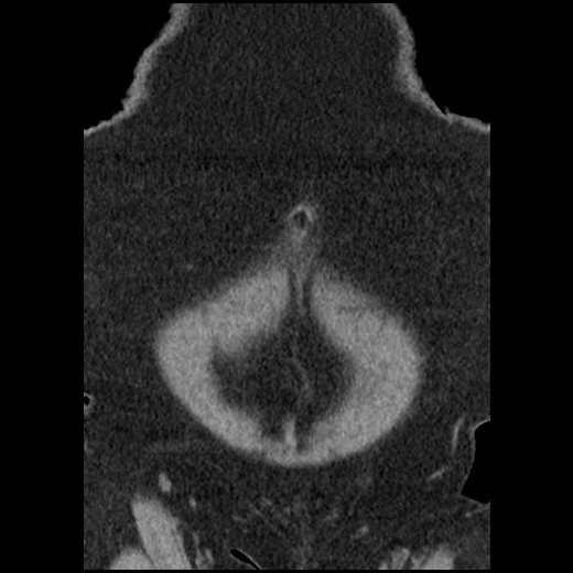 Acute cholecystitis and ureteric colic (Radiopaedia 42330-45444 Coronal prone 18).jpg