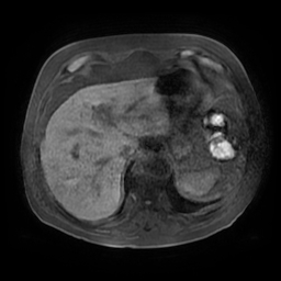 Acute cholecystitis complicated by pylephlebitis (Radiopaedia 65782-74915 Axial T1 fat sat 20).jpg