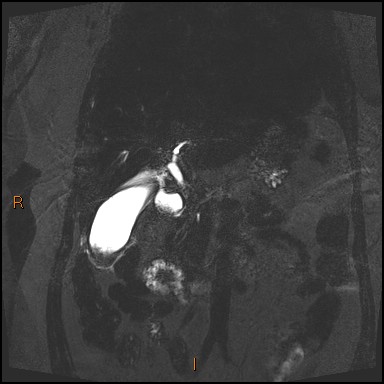 File:Acute cholecystitis with gallbladder neck calculus (Radiopaedia 42795-45971 Coronal Turbo spin echo 28).jpg