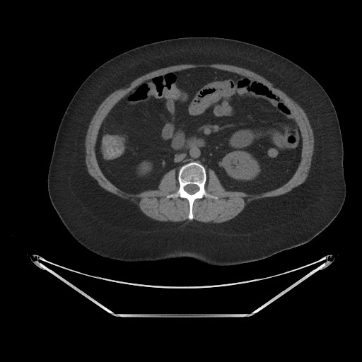 Acute cholecystitis with tensile fundus sign (Radiopaedia 71394-81723 Axial non-contrast 44).jpg
