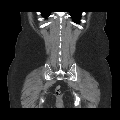 File:Acute cholecystitis with tensile fundus sign (Radiopaedia 71394-81723 Coronal non-contrast 99).jpg