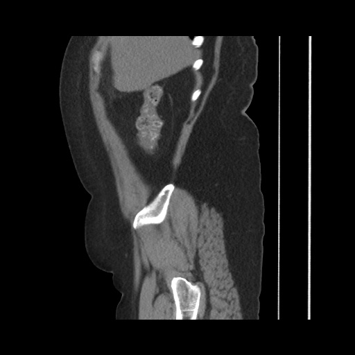 Acute cholecystitis with tensile fundus sign (Radiopaedia 71394-81723 Sagittal non-contrast 44).jpg