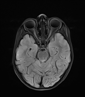 File:Acute disseminating encephalomyelitis with bilateral optic neuritis (Radiopaedia 79676-92886 Axial FLAIR 9).jpg