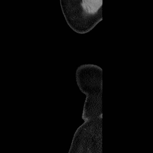 Acute diverticulitis with localized perforation (Radiopaedia 41296-44113 Sagittal C+ portal venous phase 5).jpg