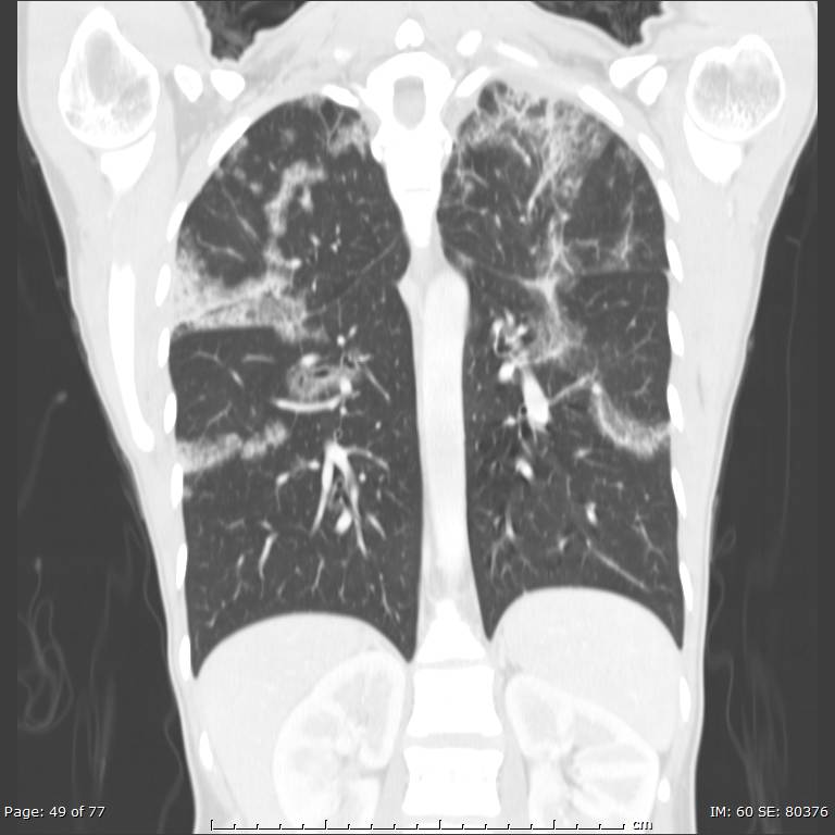 Acute eosinophilic pneumonia (Radiopaedia 48211-53073 Coronal lung window 33).jpg
