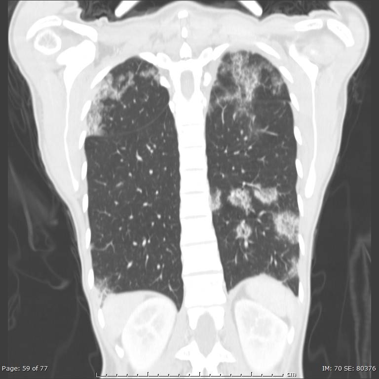 Acute eosinophilic pneumonia (Radiopaedia 48211-53073 Coronal lung window 40).jpg