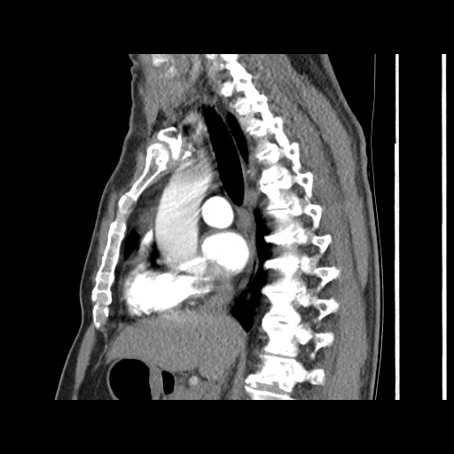 Acute epicardial fat necrosis (Radiopaedia 42327-45440 Sagittal C+ CTPA 35).jpg