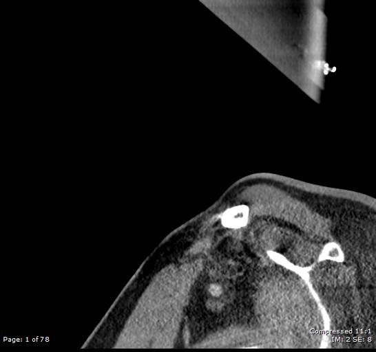 Acute epiglottitis (Radiopaedia 54375-60590 Sagittal C+ arterial phase 1).jpg