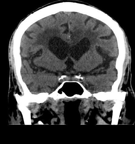 Acute left anterior cerebral artery territory infarction (Radiopaedia 51785-57578 Coronal non-contrast 25).jpg
