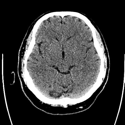 File:Acute left middle cerebral artery territory ischemic stroke (Radiopaedia 35688-37223 Axial non-contrast 33).png