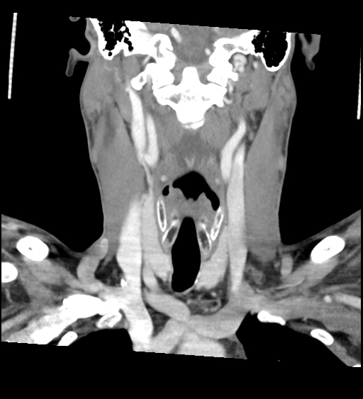 Acute longus colli calcific tendinitis (Radiopaedia 72495-83036 Coronal C+ arterial phase 33).jpg