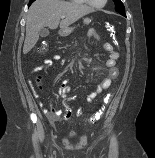 Acute mesenteric venous ischemia (Radiopaedia 46041-50383 Coronal C+ portal venous phase 35).jpg