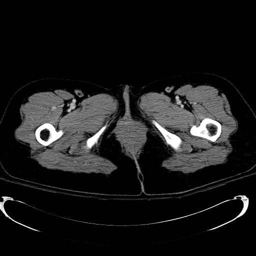 File:Acute myocardial infarction in CT (Radiopaedia 39947-42415 Axial C+ portal venous phase 151).jpg