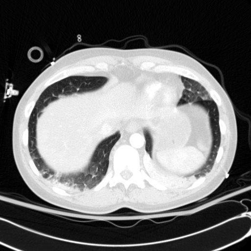 Acute myocardial infarction in CT (Radiopaedia 39947-42415 Axial lung window 113).jpg