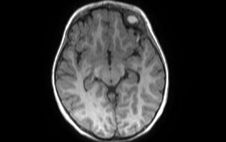 Acute necrotizing encephalitis of childhood (Radiopaedia 67356-76737 Axial T1 55).jpg