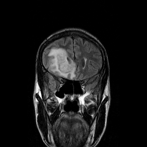 File:Acute necrotizing toxoplasma encephalitis (Radiopaedia 10683-11149 Coronal FLAIR 15).jpg