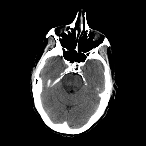 File:Acute necrotizing toxoplasma encephalitis (Radiopaedia 10683-11150 Axial non-contrast 24).jpg