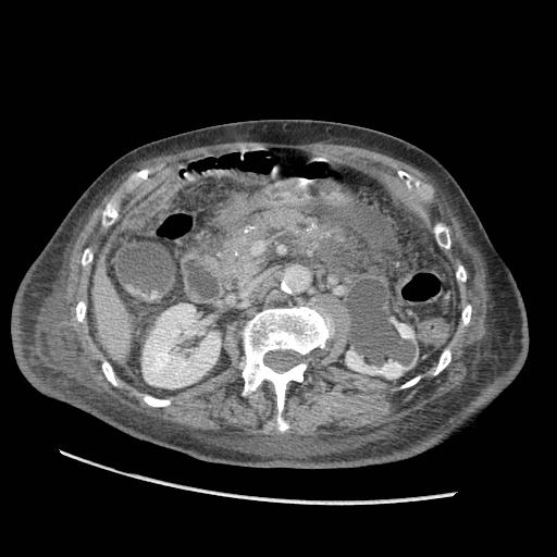 Acute on chronic pancreatitis (Radiopaedia 13233-13244 Axial C+ portal venous phase 43).jpg