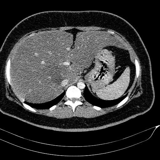 Acute on chronic pancreatitis (Radiopaedia 80902-94423 Axial C+ portal venous phase 34).jpg