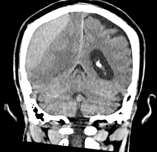 Acute on chronic subdural hematoma (Radiopaedia 78346-90966 Coronal non-contrast 47).jpg