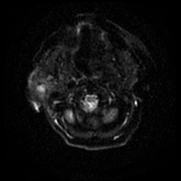 Acute otitis externa (Radiopaedia 57296-64236 Axial DWI 41).jpg