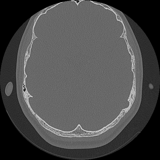 Acute otomastoiditis and Bezold abscess (Radiopaedia 88184-104786 Axial bone window 55).jpg
